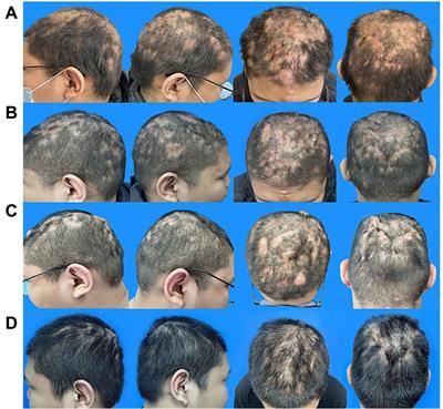 Perifolliculitis capitis abscedens et suffodiens treatment with tumor necrosis factor inhibitors and baricitinib: A case report and literature review